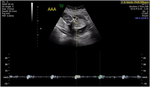 Figure 1. Fetal bradycardia (99 bpm) of the SIUGR twin prior to starting the surgical procedure.
