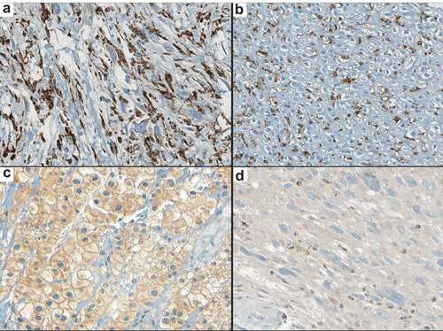 Figure 1. Immunohistochemical staining of macrophage and checkpoint biomarkers in sarcoma tissues. (a) CD68 (KP1 antibody), dedifferentiated liposarcoma; (b) CD163 (10D6), osteosarcoma; (c) CD47 (B6H12), chordoma; (d) SIRPα (A-1), dedifferentiated liposarcoma