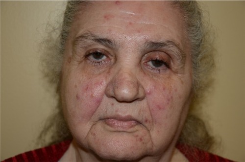 Figure 2 Papulopustular rosacea.