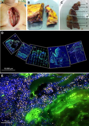 Figure 1 Sampling workflow of deep sternal wounds for wound mapping and biofilm analysis by fluorescence in situ hybridization (FISH). (A) – Deep sternal wound during surgery, the inset marks the sampling area for FISH. (B) - Tissue sample marked with surgical suture for orientation during sample processing. (C) Sample processing for FISH and wound mapping. The tissue sample was sectioned into regions a-g that were analyzed separately from each other. (D) FISH analysis of the wound regions a-c, e and g Separate FISH images are assembled together in an overview of the wound to allow exact orientation. (E) Magnification of a wound region with extensive bacterial biofilm. Green – tissue background, blue – nucleic acid stain DAPI staining bacteria and host nuclei, orange – pan-bacterial probe EUB338-Cy3. The nonsense control probe NONEUB338-Cy5 gives no signal in magenta, thus validating the EUB338-signal.