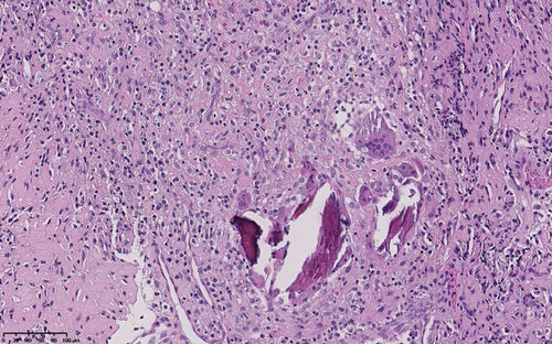 Figure 3 Postoperative H&E staining of the 5th cervical vertebra showing typical characteristics of chronic inflammation.