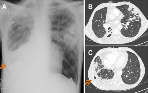 Figure 2 Chest X-ray (A) and thorax computed tomography scan (B–C) revealing multifocal pneumonia with right pleural cavitation due to Actinomyces viscosus.Note: Arrows indicate chest wall sinus tract.