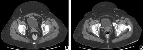 Figure 1 Axial CT images showing multiple abnormal nodular thickening on the anterior (A) and posterior (B) bladder walls.