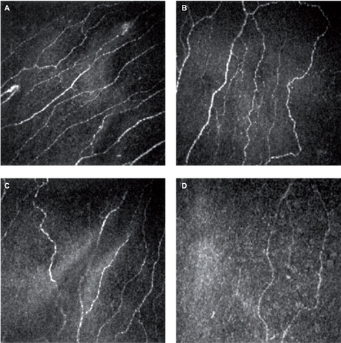 Figure 1 Subbasal nerves plexus of normal subject (A), nontreated glaucoma patient (B), prostaglandin analog treated patient (C) and beta-blocker treated patient (D).