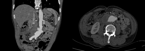 Figure 1 A 62-year-old male patient with abdominal aortic aneurysm. Abdominal aortic lobulated cystic aneurysm, with a surrounding low-density shadow.