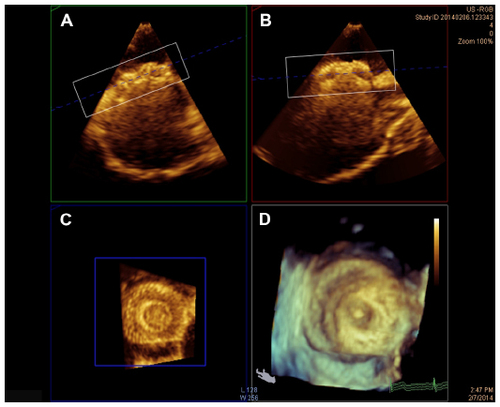 Figure 3 Demonstration of 3D image cropping to achieve optimal right atrial view of a 13 mm Amplatzer septal occluder device as obtained by intra-procedural 3D transesophageal echocardiography. Orthogonal axial (A), sagittal (B), and coronal (C) oblique views are shown along with the 3D image (D).