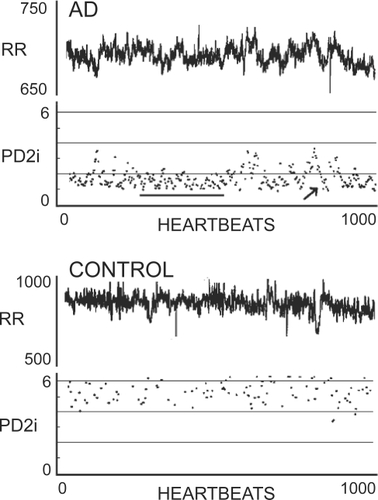 Figure 2 RR intervals and associated PD2is from two types of patients. Upper panel shows RR data and corresponding PD2i results from a patient who experienced documented arrhythmic death (AD) within 24 hours; note the two patterns of either a sustained low-dimension (line) or the systematic low-dimensional excursion (arrow). The lower panel shows data and results from a normal patient discharged after diagnosis of gastro-esophageal reflux disorder (CONTROL).