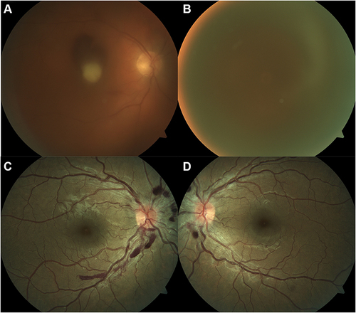 Figure 1 Fundoscopic presentation of two patients with bilateral Terson syndrome. (A and B) show, respectively, the right and left eyes of a patient with multiple peripapillary pre-retinal haemorrhages after traumatic brain injury (patient 6 in Table 3). The second set of images belongs to a patient with a subarachnoid haemorrhage due to rupture of an anterior communicating artery aneurysm (patient 8 in Table 3). The right eye (C) presented with a discrete vitreous haemorrhage and a dense pre-retinal macular haemorrhage, while the left eye (D) shows a very dense vitreous haemorrhage.