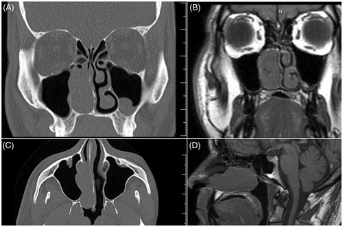 Figure 1. Imaging confirms infrasellar craniopharyngioma isolated to the nasal cavity. (A) Coronal CT showing a right-sided nasal mass extending into the maxillary sinus with proximity to the nasolacrimal duct. (B) Coronal MRI showing a right-sided nasal mass extending into the maxillary sinus with proximity to the nasolacrimal duct with no intracranial extension of the mass. (C) Axial CT showing mass in the right nasal cavity extending into the maxillary sinus without evidence of intracranial involvement or contact with the skull base. (D) Sagittal MRI showing a mass in the right nasal cavity with no contact with the skull base. (Ruler markings indicate 1cm segments).
