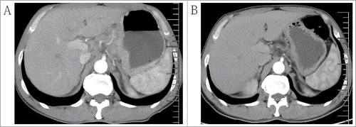 Figure 1. (A) Enhanced CT prior to preoperative chemotherapy, a mass in the gastric wall. (B) Enhanced CT following three cycles of preoperative chemotherapy revealing that the lesion was clearly decreased in size.