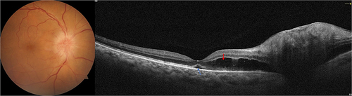 Figure 3 Representative case of acute non-arteritic anterior ischemic optic neuropathy with intraretinal and subretinal fluid. A 55-year-old hypertensive male patient presented with a 10-day history of drop of vision in the right eye which measured to an acuity of 6/12 on examination. Fundus examination and photography (left panel) showed an elevated disc with peripapillary edema. Optical coherence tomography (right eye) showed intraretinal fluid within the outer nuclear layer (red arrow) and a small pocket of subretinal fluid in the foveal area (blue arrow).