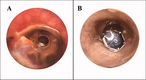 Figure 1. (A) Example of the original lens of the Earlens system which had a small mass on the platform that contacted the tympanic membrane (TM), and the full mass was borne by the TM. (B) Example of the newer photonic lens of the Earlens system where the majority of the mass of the lens is stabilised by a supporting platform which resides at the medial end of the bony canal, and only a small portion comes into contact with the TM the umbo (not visible, the TM contacting platform is underneath the motor that is suspended across the TM).