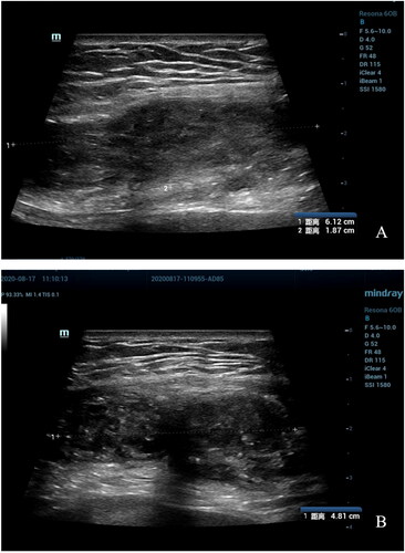 Figure 1. B-Ultrasound for patient before HIFU (Aug. 17th, 2020). The B-Ultrasound for patient showed the mass is 61.20 × 18.70 × 48.10 mm.