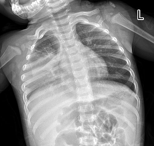 Figure 1 The girls' chest Xray showed pneumonia on the side.