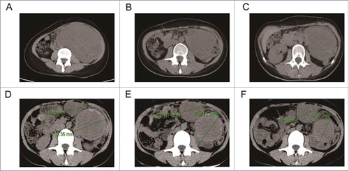 Figure 4. Chest CT images showed abdominal mass before (A) and after treatment with apatinib (B&C); new increased lesions before (D) and after treatment with apatinibin combination with paclitaxel (E and F).
