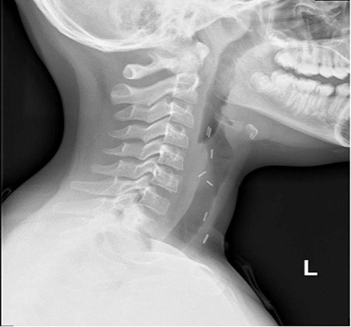 Figure 3 X-ray imaging showing multiple metallic clips over the anterior neck.