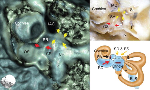 Figure 1. 3D CT image of the reuniting duct (RD), saccular duct (SD) and endolymphatic sinus (ES) of a healthy volunteer's ear (left), cadaver's ear (upper right), and schematic view (lower right). All these views are left ears. Red arrows show the RD and yellow arrows show the SD and ES. CR, cochlear recess; EnS, endolymphatic sac; IAC, internal auditory canal; L, lateral semicircular canal; OS, osseous spiral lamina; P, posterior semicircular canal; S, superior semicircular canal; SA saccule; SR, saccular recess; UR, utricular recess.