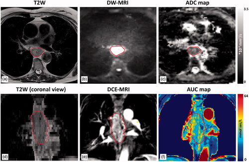 Figure 1. An example of acquired MRI scans for one patient for one time point (pre scan). In (a) a T2W scan is shown with in (d) the coronal view of the same scan. (b) A b800 DW-MRI scan and its corresponding ADC-map in (c). In (e) the 24th scan of a DCE-MRI series is shown, during inflow of contrast in the tumor. The corresponding calculated AUC-map is found in (f).