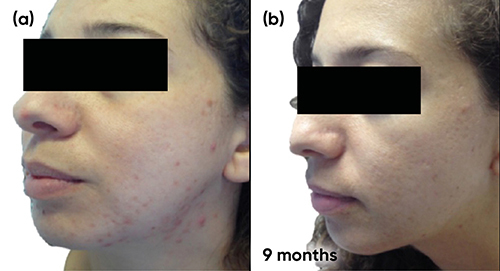 Figure 10 Case study 4 improvement on left-hand side of face, baseline to 9 months (a) Baseline (b) 9 months with COC (ethinylestradiol 0.02mg plus drospirenone 3mg) plus spironolactone 25mg twice a day, plus AZA gel 15% twice daily.