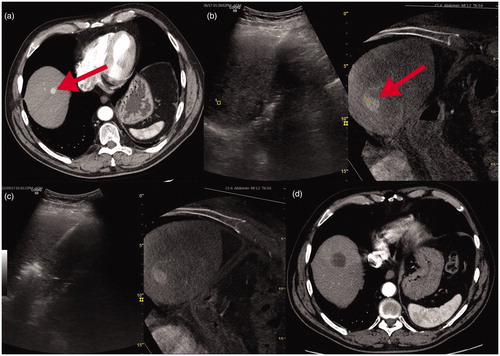 Figure 1. (a) Small HCC node in the liver dome at baseline MDCT evident as focal contrast enhancement (red arrow). (b) US fusion with contrast enhanced CBCT: HCC node is barely detectable with US alone but this visualisation improves due to fused CBCT node visualisation (red arrow). (c) the subsequent needle-antenna deployment and ablation. d-1 month MDCT control.