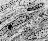 Fig. 2 Dermatofibrosarcoma. Electron micrograph showing spindle cells with scanty cytoplasm containing scanty profiles of rough endoplasmic reticulum and no other specific features.