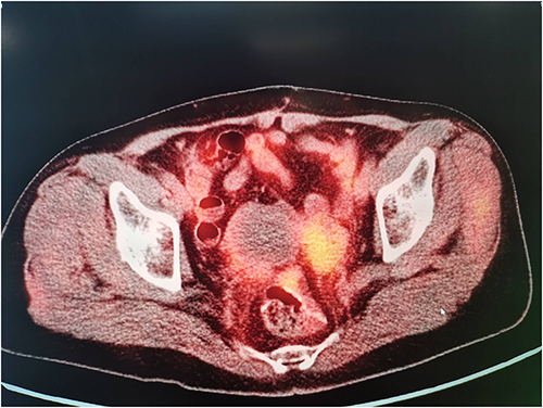 Figure 5 The FDG metabolism of multiple omentum nodules and pelvic peritoneal nodules which have unclear boundary with the anterior wall of rectum was increased.