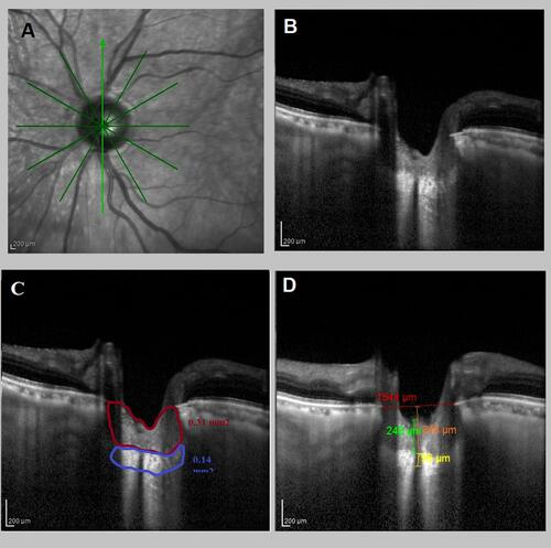 Figure 2 Left eye of a mild POAG patient (MD = −5.51). (A) The axial scans of the optic nerve head. (B) The enhanced depth imaging with spectral-domain optical coherence tomography (EDI-OCT) device (Spectralis, Heidelberg Engineering, Heidelberg, Germany) of lamina cribrosa. (C) EDI-OCT assessment of LC showed that: Blue square showing the lamina cribrosa area (0.14 mm2) and the red square prelaminar neural tissue area (0.31 mm2). (D) EDI-OCT assessment of LC showed that: yellow line showing LC thickness 96 µm, green line showing prelaminar neural tissue thickness (248 µm), and orange line showing anterior lamina cribrosa surface depth (348 µm). Red line showing reference line connecting both ends of Bruch’s membrane opening.