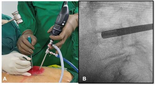 Figure 4 (A) Insertion of reamer under fluoroscopic view. (B) Confirmation on image intensifier.