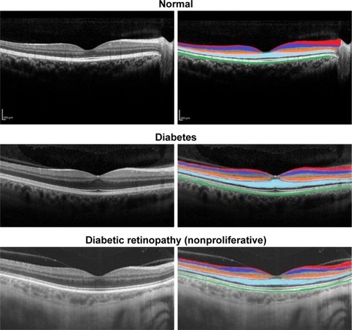 Figure 1 Retinal OCT images showing six layers and their thicknesses highlighted in different colors.