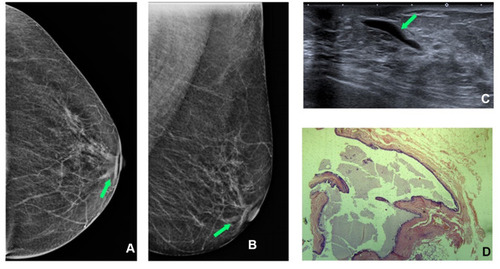 Figure 3 Left mammogram SDD (green arrow) at cranio-caudal (CC) (A) and medio-lateral oblique (MLO) (B) mammogram view. Targeted US shows anechoic intraductal content (green arrow) (C); (D) H&E staining (x10) shows ductal ectasia.