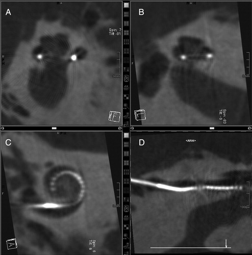 Figure 14. MRA (version 5) rotational tomography following human temporal bone insertion: (A and B) different mid-modiolar views, (C) transcochlear view, and (D) curved reformation of the MRA array located in the basal scala tympani. Images courtesy of University of Freiburg, Germany.