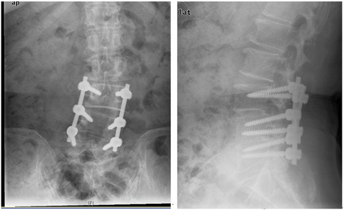 Figure 4 Postoperative X-ray, L3–5 Instrumentation, (posterior).