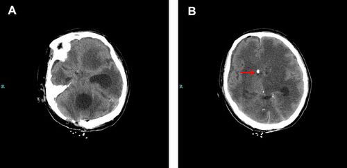Figure 3 Brain computed tomography scan of case 2. (A) The CT images show blocking of the right lateral ventricle but with obvious enlargement of the left lateral ventricle and the fourth ventricle, which indicate separation of the ventricular system. (B) Red arrow show the drainage tube.