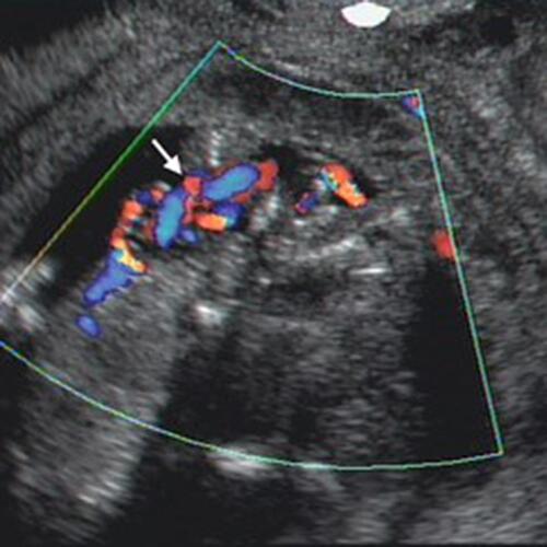 Figure 2 Transvaginal color Doppler imaging of entangled/entwined umbilical cords of monochorionic monoamniotic twins at 10 weeks’ gestation. Arrow points to “branching” of the umbilical artery indicative of cord entanglement. One week later both fetuses had succumbed following the entanglement.Note: Reproduced with permission from Sherer DM, Sokolovski M, Haratz-Rubinstein N. Diagnosis of umbilical cord entanglement of monoamniotic twins by first-trimester color doppler imaging. J Ultrasound Med. 2002;21(11):1307. © 2016 by the American Institute of Ultrasound in Medicine.Citation13