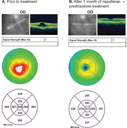 Figure 2 Acute pseudophakic CME: Patient #6 OCT images. A) The patient shows retinal edema, with a retinal thickness of 448 μm prior to treatment. B) The patient shows resolution of retinal edema, with a retinal thickness of 211 μm after one month of treatment with nepafenac + prednisolone.