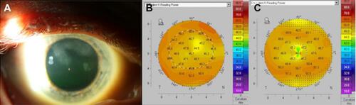 Figure 3 Clinical images of a 58-year-old white male with history of diabetes, cataracts, and trauma to the right eye 40 years prior who presented with Salzmann nodular degeneration in both eyes. Best-corrected visual acuity (BCVA) in the right eye was 20/30 with a correction of −1.25+3.00 x 93. (A) Slit-lamp photograph depicts multifocal, large white-gray corneal opacities in the superior periphery extending centrally. (B) Tomography reveals mildly irregular astigmatism (simK astigmatism 2.0 diopters). (C) 7 weeks after undergoing superficial keratectomy, nodule removal, photokeratectomy, and intra-operative mitomycin-C application, BCVA remained 20/30 but manifest refraction improved to −1.00+0.50 x 95. Tomography reveals improvement in irregular astigmatism (simK astigmatism 0.8 diopters). The patient is now scheduled to undergo cataract extraction.