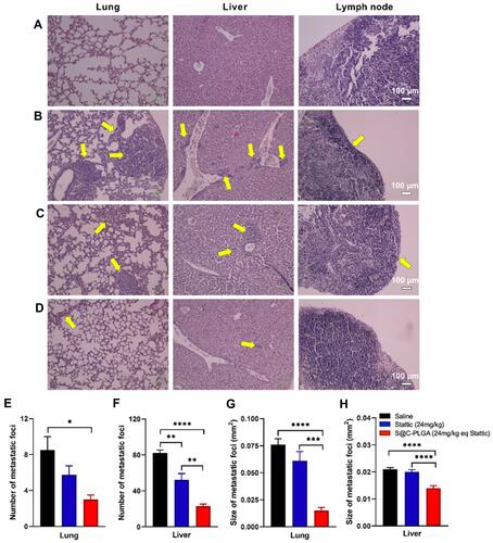 Figure 6 In vivo antimetastatic effects of S@C-PLGA NPs. Histopathological analysis and quantification of metastatic foci for lung, liver, and lymph node of untreated control mice (A) and 4T1 tumor-bearing mice treated with multiple doses of saline (B), Stattic (24 mg/kg) (C) and S@C-PLGA NPs (24 mg Stattic eqv./kg) (D). No metastatic foci were observed in heart, kidney and spleen. Quantification of number of metastatic foci found in lung (E) and liver (F) by observing 5 and 8 images in lung and liver, respectively, for each mouse in all the treatment groups. Average sizes of metastatic foci found in lung (G) and liver (H) for each treatment group. Data represent the mean number of metastatic foci ± SEM (n=4); *, **, *** and ****Indicate p <0.05, 0.01, 0.001 and 0.0001, respectively as assessed by One-way ANOVA with Dunnett’s post-hoc test. Yellow arrows indicate metastatic foci.