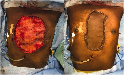 Figure 5. Intraoperative view with LD muscular free flap (left) and skin graft (right).