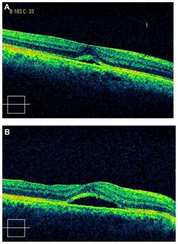 Figure 1 (A) Spectral-domain optical coherence tomography of the right eye of the patient 5 months after vitrectomy and buckle surgery for retinal detachment showing subretinal fluid in the foveal area with thickened inner limiting membrane; (B) inner limiting membrane subfoveal fluid accumulation persisted 2 weeks after peeling.
