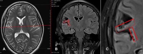 Figure 3 Pre-radiosurgery coronal (A), axial (B) and zoom out (C) view magnetic resonance images showing residual lesions in the operculo-insular area (within the red rectangles).