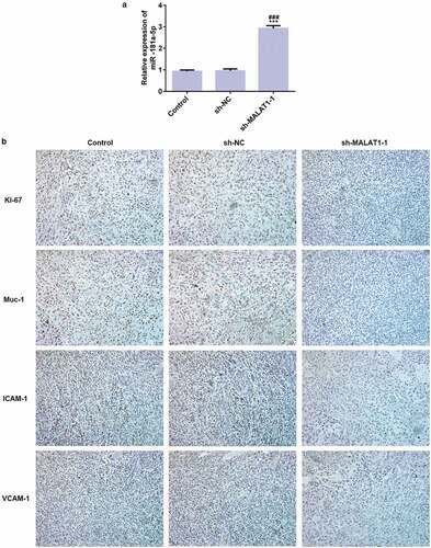 Figure 10. LncRNA MALAT1 interference inhibits the expression of proliferation and adhesion related proteins. (a) The expression of miR-181a-5p in tumor after transfection. ***P < 0.001 vs. control group. ###P < 0.001 vs. sh-NC group. (b) The expression of proliferation (Ki-67) and adhesion (Muc-1, ICAM-1, and VCAM-1) related proteins was detected by immunohistochemistry