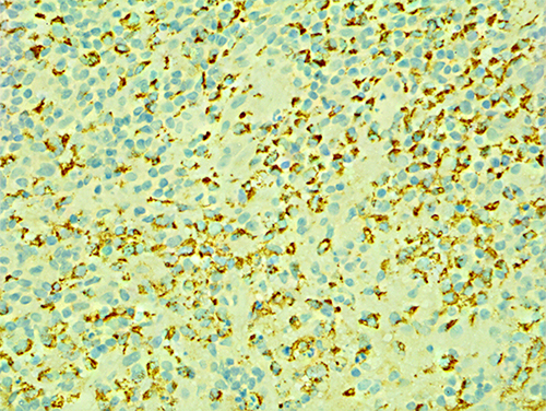 Figure 5 Pathological CD68 IHC image of lymph node (40X).