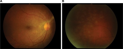 Figure 4 Panretinal photocoagulation of the right eye at ischemic area was performed.