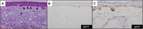 Figure 1 MiTF accurately enumerates the melanocytes in the epidermis of chronic sun exposed skin and in lesions of lentigo maligna.