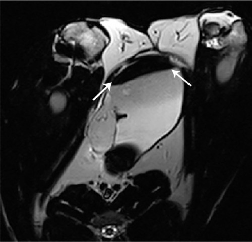 Figure 5 MRI of the PL-SF scaffold seeded with iron-labeled BMSCs after 8 weeks of implantation.Note: The scaffold is indicated by white solid arrows.Abbreviations: BMSCs, bone marrow stromal cells; MRI, magnetic resonance imaging; PL-SF, poly-l-lactide/silk fibroin.