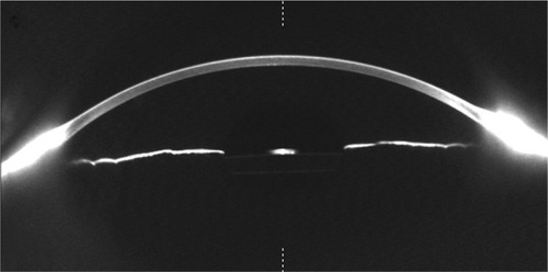 Figure 6 Anterior segment photography of the right eye using a Scheimpflug-based camera.