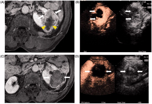 Figure 1. Images of a 77-year-old man who had CEUS-guided percutaneous MWA of RCC performed after cryoablation. (A) Contrast-enhanced MRI shows a residual tumour (white arrows) around the necrotic tissue (arrowheads) in the left kidney. (B) Residual tumour was undetectable on conventional ultrasound, while the CEUS cortical phase image shows a 6.0 × 4.1 cm tumour in the left kidney (arrows) and there was no enhancement in the necrosis area in the centre of the whole tumour. (C) Enhancement of the tumour in cortical phase (arrow) was not showed in contrast-enhanced MRI 11 months after treatment. (D) Cortical phase of CEUS obtained 6 months after CEUS-guided percutaneous MWA shows complete necrosis of the tumour (arrows).