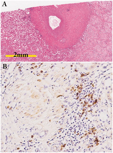 Figure 6. Periarterial lesion and perineural lesion. (A) Marked periarterial fibrosis of interlobar artery (periodic acid-Schiff staining); (B) IgG4-positive plasma cell infiltration in the perineural lesion in a patient with IgG4-ureteritis who underwent nephrectomy (IgG4 immunostaining ×400).