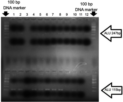 Figure 1 A number of cancerous samples were examined after amplification by real-time PCR. The products were mixed with loading buffer and loaded on 2% agarose gel. Lanes 1–12 are examined samples. The sequences of ALU247 (above) and ALU115 (at the bottom) are clearly visible. The first and the last wells show the 100 bp DNA marker.