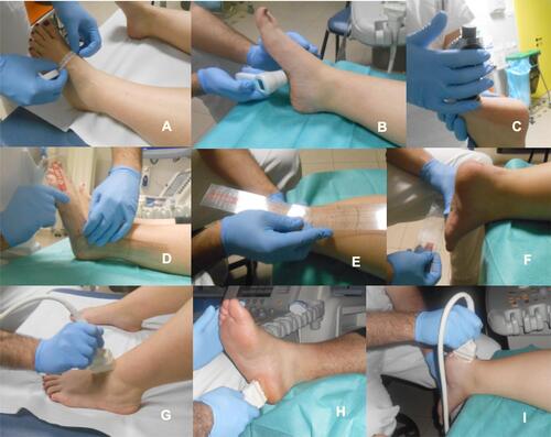 Figure 1 Practical assessment of anthropometric parameters (A), skin temperature (B), skin hardness (C), osteoarticular parameters (D–F) and ultrasound analysis at dorsum of the foot (G), at plantar surface (H) and Achilles tendon (I).